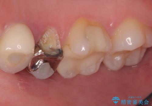【セラミッククラウン】銀の詰め物していた歯が割れたの治療前