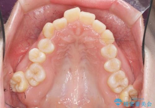 サクソフォン(アルト)の演奏で崩れてしまった歯並び、マウスピース矯正治療の治療前