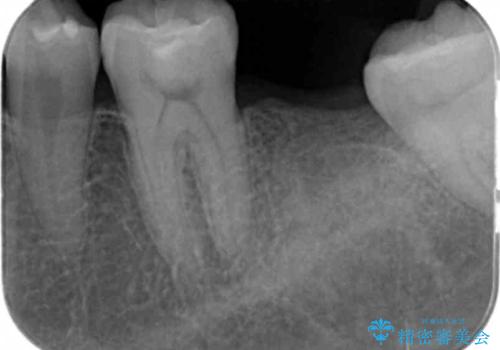 奥歯のインプラントの治療前