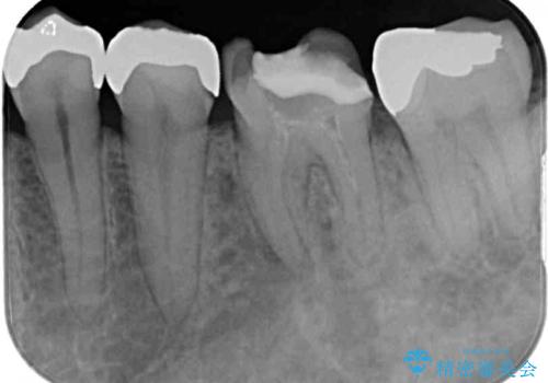 何度通院しても痛みが引かない 転医による根管治療の治療前