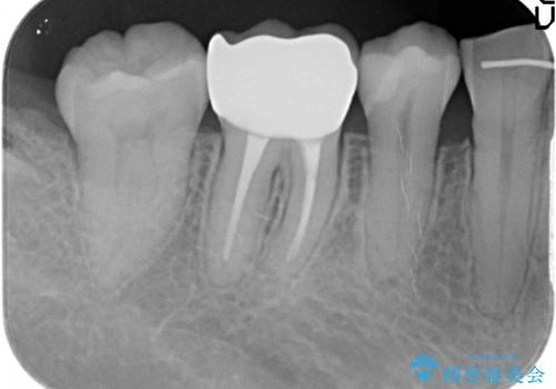 治療途中の歯　セラミック治療を希望され来院の治療後