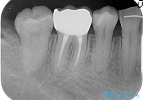 治療途中の歯 セラミック治療を希望され来院の治療後