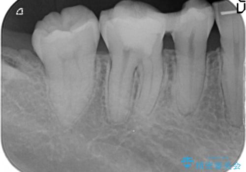 治療途中の歯 セラミック治療を希望され来院の治療前