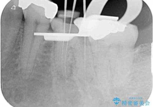 何度通院しても痛みが引かない 転医による根管治療の治療中