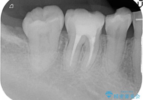 治療途中の歯 セラミック治療を希望され来院の治療中