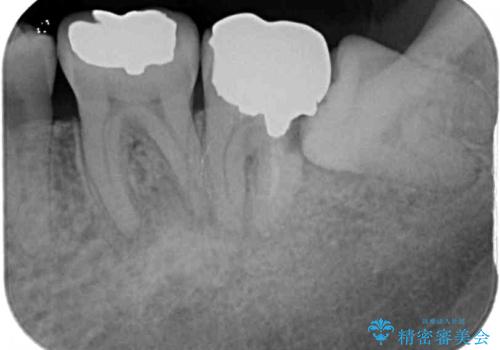 受け口を治す ワイヤー装置での矯正治療の治療前