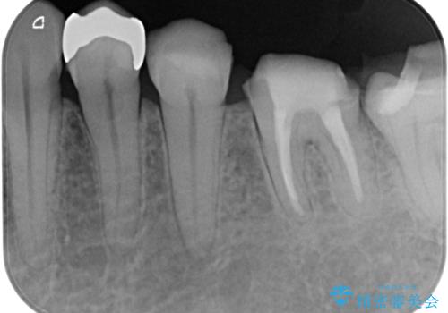 何度通院しても痛みが引かない　転医による根管治療の治療中