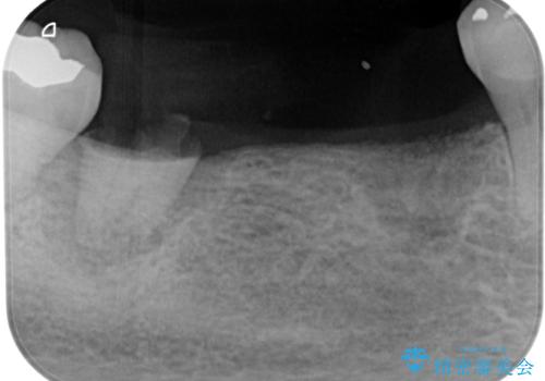 入れ歯が全く使えない　奥歯のインプラント治療の治療前