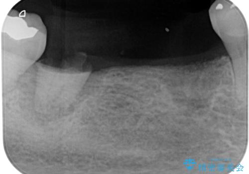 入れ歯が全く使えない 奥歯のインプラント治療の治療前