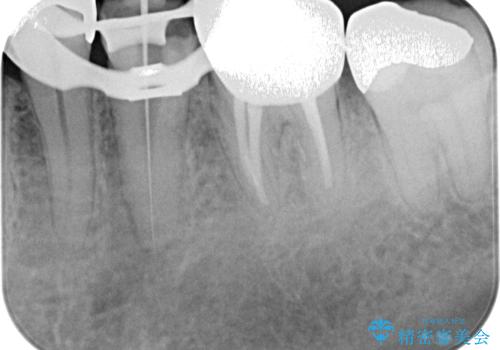 何度通院しても痛みが引かない 転医による根管治療の治療中