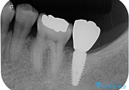 受け口を治す ワイヤー装置での矯正治療の治療後