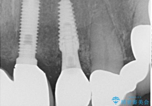 1DAYインプラント 土台から外れてしまった前歯を短期間で治療の治療後