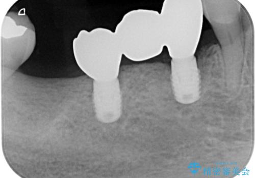 入れ歯が全く使えない　奥歯のインプラント治療の治療後