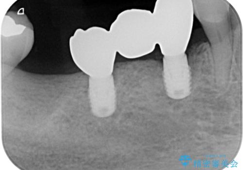 入れ歯が全く使えない 奥歯のインプラント治療の治療後
