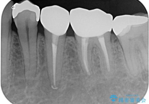 何度通院しても痛みが引かない 転医による根管治療の治療後