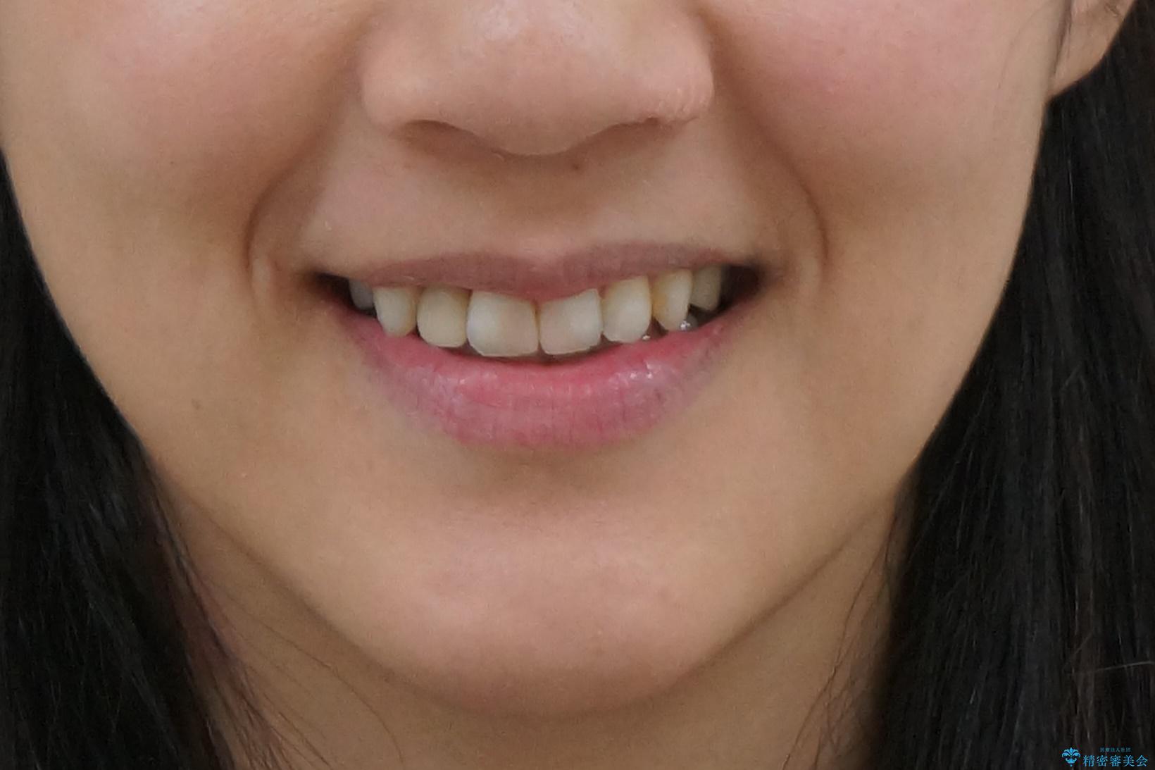 あきらめないで!!虫歯でボロボロでも大丈夫! 非抜歯矯正と虫歯、インプラント治療で見違える歯並びに。の治療後(顔貌)