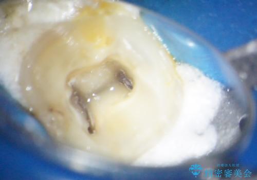 何度通院しても痛みが引かない 転医による根管治療の治療前