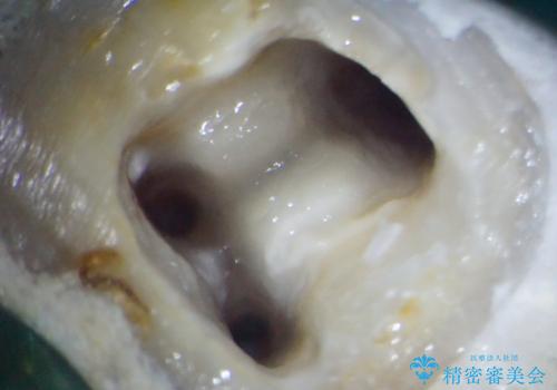 何度通院しても痛みが引かない 転医による根管治療の治療中