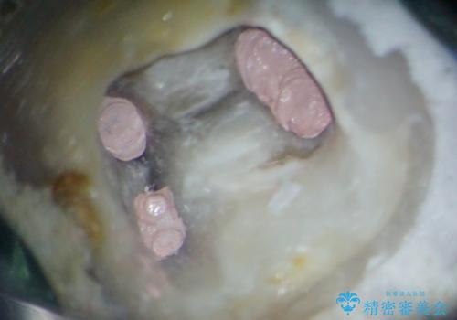 何度通院しても痛みが引かない 転医による根管治療の治療後