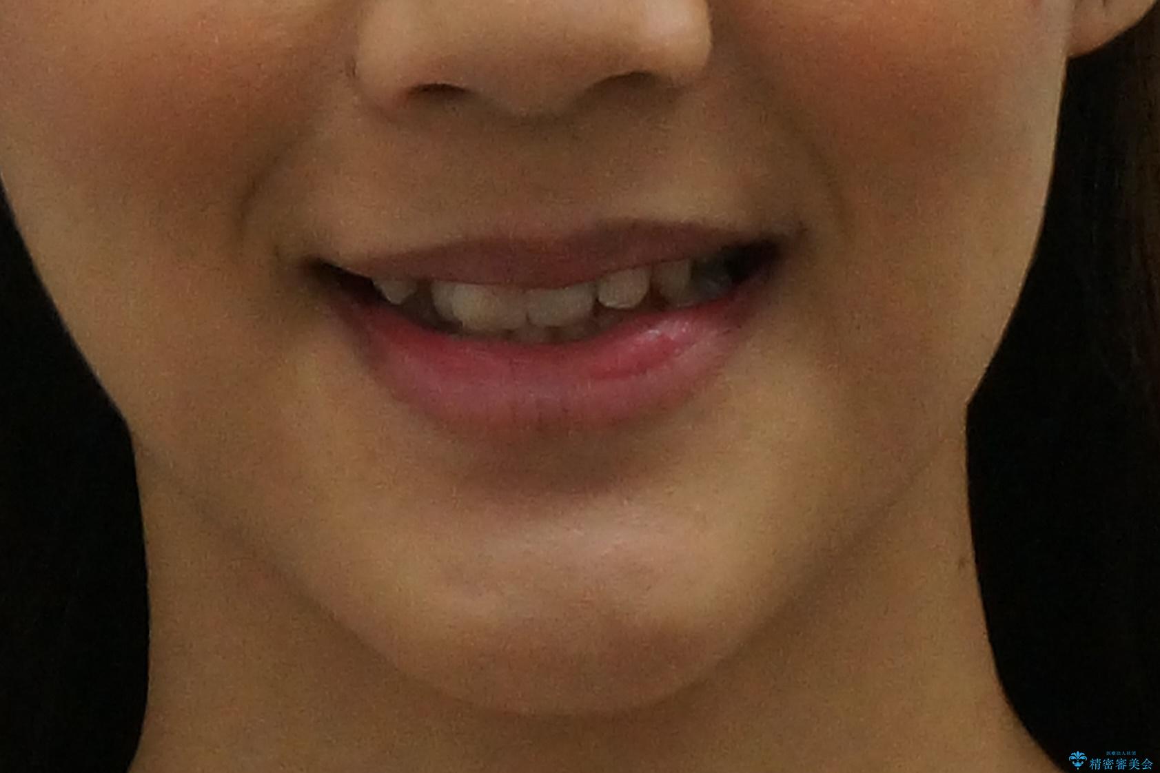 あきらめないで!!虫歯でボロボロでも大丈夫! 非抜歯矯正と虫歯、インプラント治療で見違える歯並びに。の治療前(顔貌)