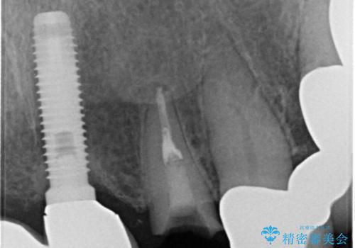 1DAYインプラント 土台から外れてしまった前歯を短期間で治療の治療前