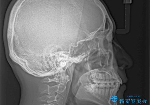 前歯のデコボコを治したい ワイヤー装置での非抜歯矯正の治療前