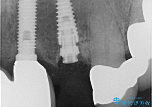 1DAYインプラント 土台から外れてしまった前歯を短期間で治療の治療中