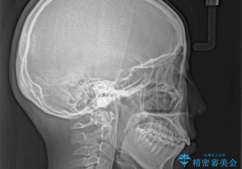 飛べ出ている出っ歯を治したい　目立たない装置での抜歯矯正治療の治療前