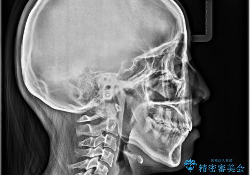 飛び出ている出っ歯を治したい 目立たない装置での抜歯矯正治療の治療後