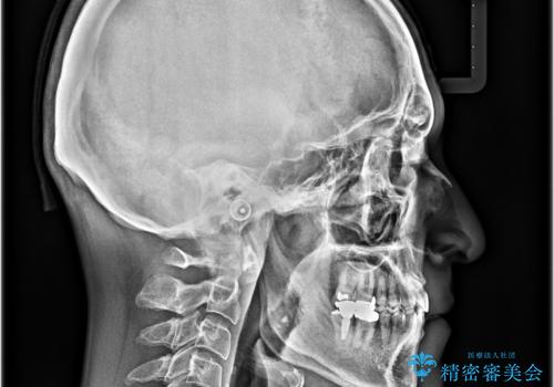 受け口を治す ワイヤー装置での矯正治療の治療後