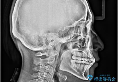 前歯のデコボコを治したい ワイヤー装置での非抜歯矯正の治療後