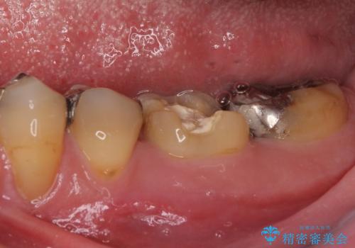 何度通院しても痛みが引かない 転医による根管治療の治療前