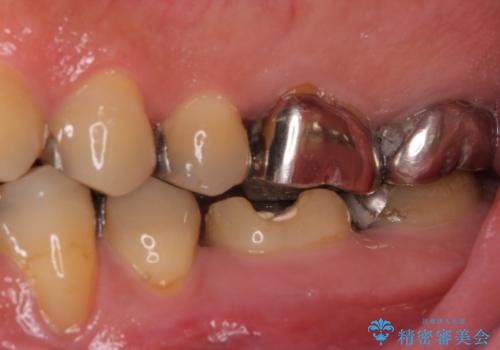 何度通院しても痛みが引かない 転医による根管治療の治療前