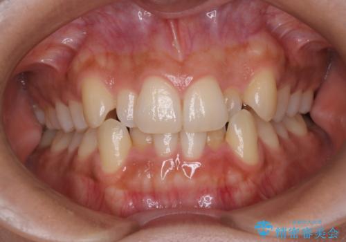 反対咬合と前歯のガタガタを非抜歯で改善の症例 治療前