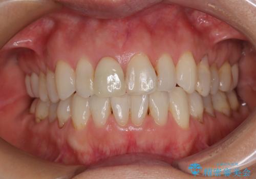 デコボコと銀歯 矯正治療とセラミック治療で綺麗な口元にの治療中