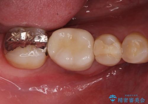歯茎が腫れた。ジルコニアクラウンやりかえ。の症例 治療後