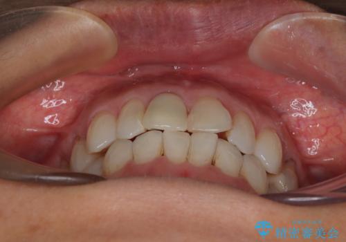 デコボコと銀歯 矯正治療とセラミック治療で綺麗な口元にの治療中