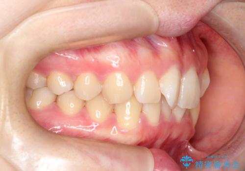 インビザラインで上下の叢生を改善の治療前
