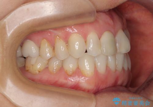 デコボコと銀歯 矯正治療とセラミック治療で綺麗な口元にの治療中