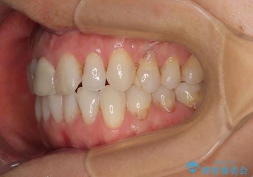 デコボコと銀歯 矯正治療とセラミック治療で綺麗な口元にの治療中