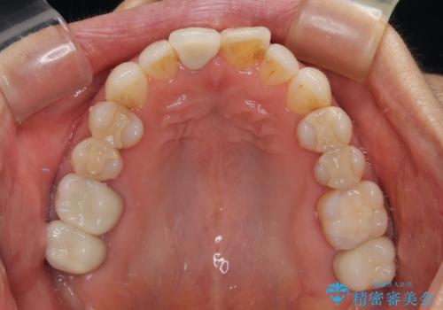 デコボコと銀歯 矯正治療とセラミック治療で綺麗な口元にの治療中