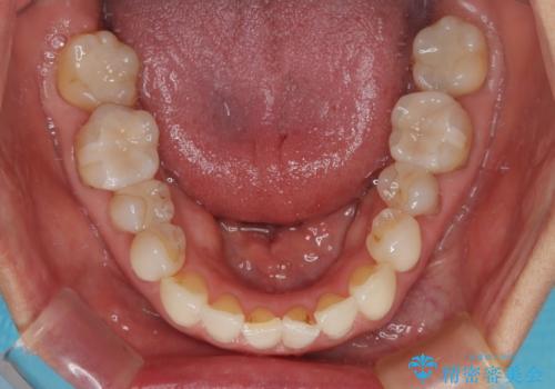 デコボコと銀歯 矯正治療とセラミック治療で綺麗な口元にの治療中