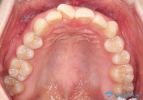 インビザラインで上下の叢生を改善の治療前