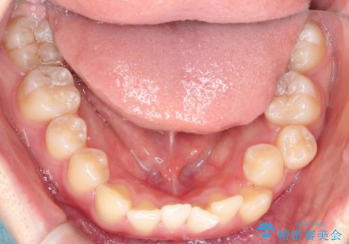 インビザラインで上下の叢生を改善の治療前