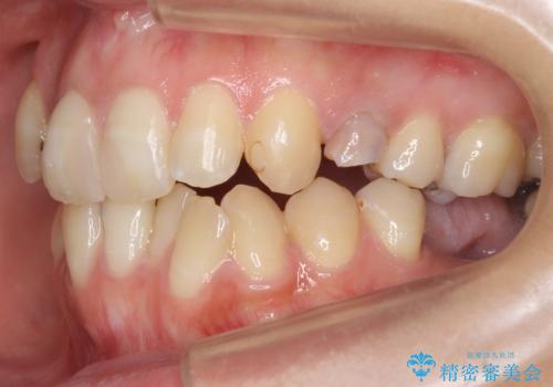 あきらめないで!!虫歯でボロボロでも大丈夫! 非抜歯矯正と虫歯、インプラント治療で見違える歯並びに。の治療前