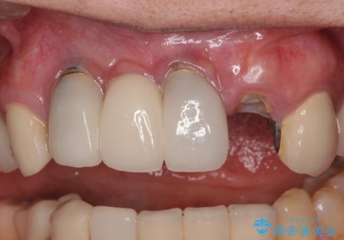 1DAYインプラント 土台から外れてしまった前歯を短期間で治療の症例 治療前