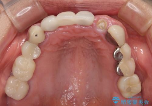 1DAYインプラント 土台から外れてしまった前歯を短期間で治療の治療前