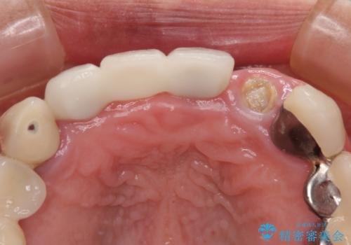 1DAYインプラント　土台から外れてしまった前歯を短期間で治療の治療前