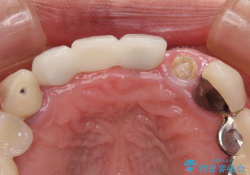 1DAYインプラント 土台から外れてしまった前歯を短期間で治療の治療前