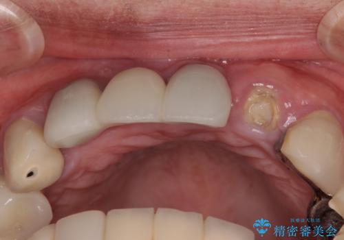 1DAYインプラント 土台から外れてしまった前歯を短期間で治療の治療前